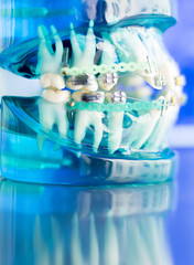 Dental teeth metal brackets