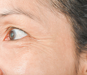 Wrinkles on the eyes
