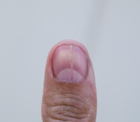 Forked nail on the thumb. Dilation of the nail, traumatic pathol