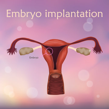 Embryo implantation. The fertilized egg, uterus, womb. Anatomy illustration. Blurred pink background.