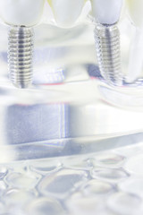 Dental titanium tooth implant