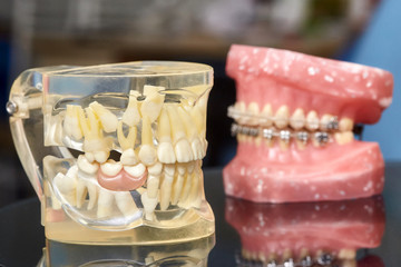 Human jaw or teeth model with metal wired dental braces