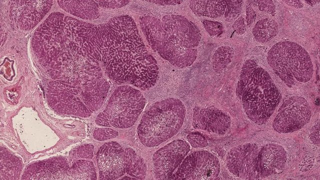 cross section cut of liver cirrhosis under the microscope