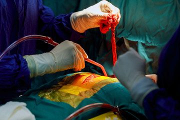 Teamwork surgeons during open-heart surgery