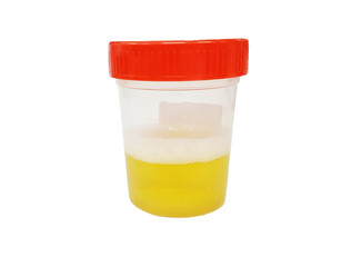 Urine sample in container isolated on white background with clipping path, Bubble in urine specimen mean protein found in a urine sample known as proteinuria, determined by urine dipstick test.