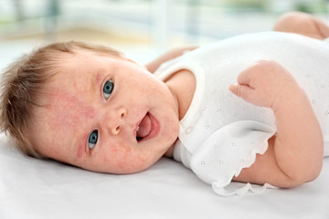 Adorable baby with skin allergy indoors