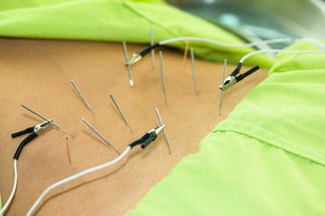 Acupuncture with Electrical stimulator