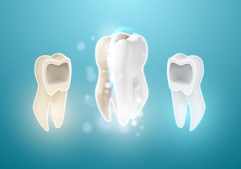 Illustration of Teeth Whitening System. 3D Realistic Vector Tooth Cleaning Process Illustration