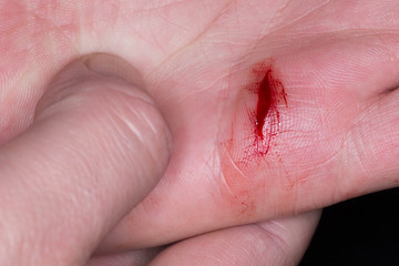 deep cut caused by knife in hand palm