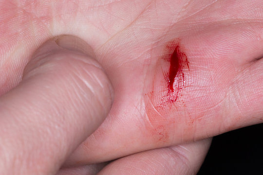 Deep Cut Caused By Knife In Hand Palm