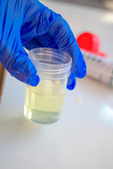Urine sample and urine analysis