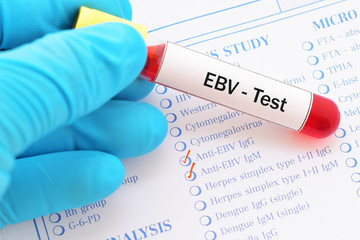 Blood sample with requisition form for Epstein-Barr virus (EBV) test