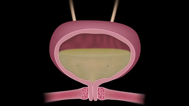 Stress urinary incontinence in women, animation