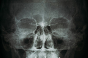 X-ray image or roentgen of human skull, close-up. Head xray scan of skeleton eyes and nose. Abstract medical clinic anatomy concept