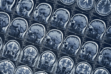 MRI brain scan or x-ray neurology human head skull tomography test