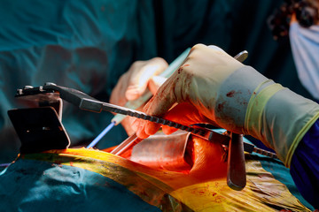 Beating human heart close-up in opened chest during the surgery