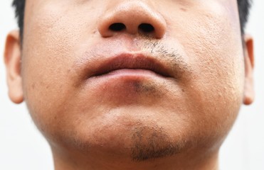 Obraz premium some mustache after withdrawal mustache on surface young asian man face skin do not take care for a long time