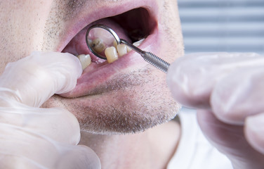 Closeup teeth, dental health care clinic with missing tooth