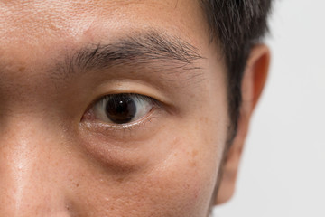 asian male man face oily skin with big eye bag at the left eye