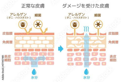 皮膚断面図 健康な皮膚とダメージを受けた皮膚の比較図 Wall Mural Barks