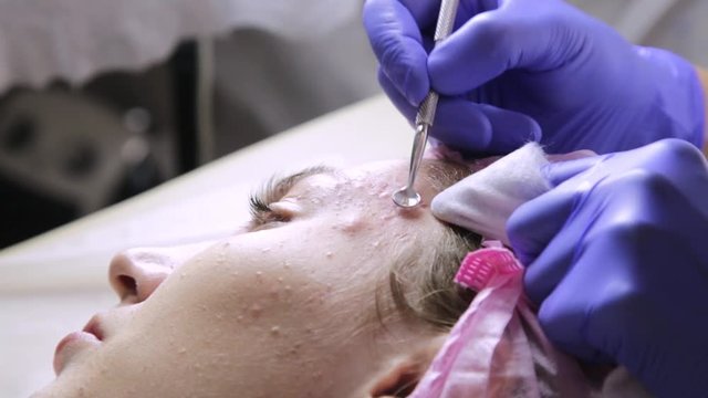 beautician squeezing pimple blackheads for young wonan in beauty salon. facial skin care