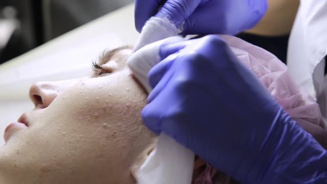 beautician squeezing pimple blackheads for young wonan in beauty salon. facial skin care