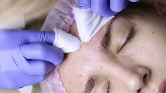 Squeezing pimple acne treatments. Young woman receiving beauty face therapy of cleaning pimple.
