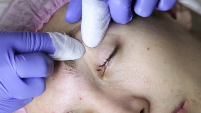 Squeezing pimple acne treatments. Young woman receiving beauty face therapy of cleaning pimple.