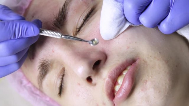 Squeezing pimple acne treatments. Young woman receiving beauty face therapy of cleaning pimple.