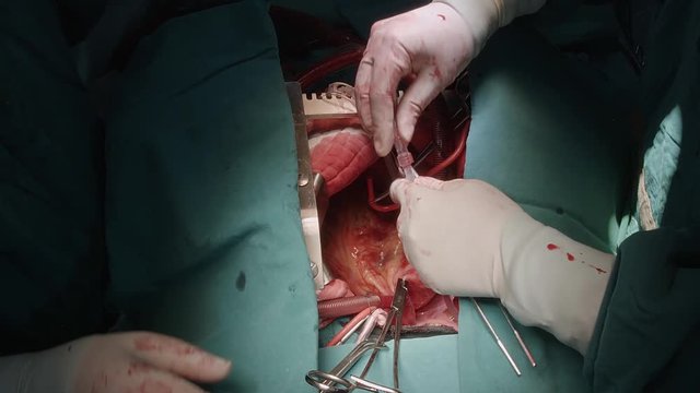 open heart surgery