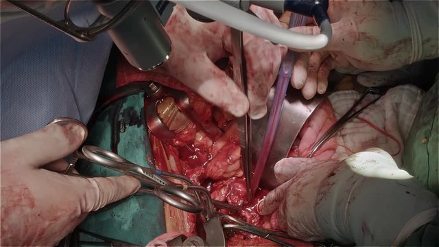 Vascular surgeon team replace infrarenal aorta for patient who had abdominal aortic aneurysm