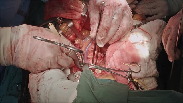 Vascular surgeon team replace infrarenal aorta for patient who had abdominal aortic aneurysm