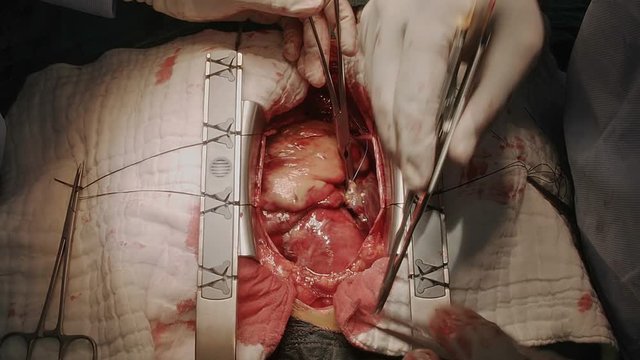 doctor perform heart surgery in operating room