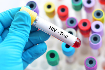 Blood for HIV test - obrazy, fototapety, plakaty