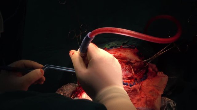 brain surgery