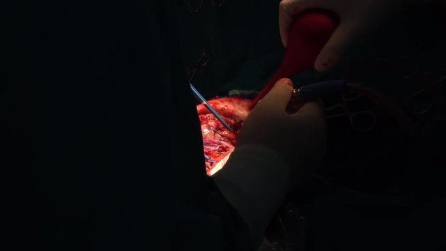 brain surgery