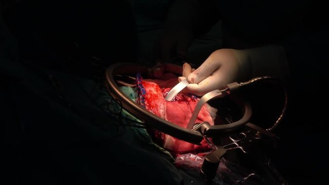 brain surgery
