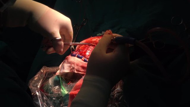 neurosurgeon perform craniotomy for patient