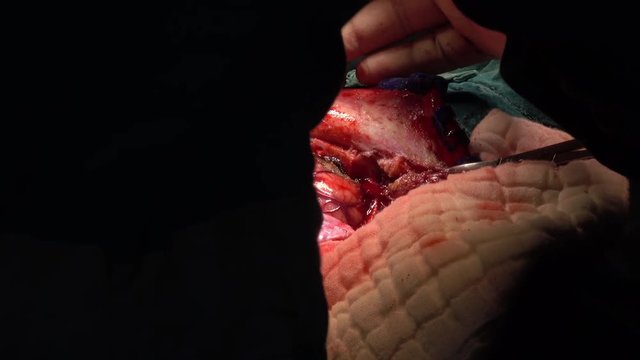 neurosurgeon perform craniotomy for patient