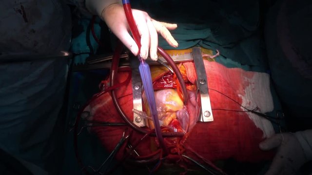 open heart surgery