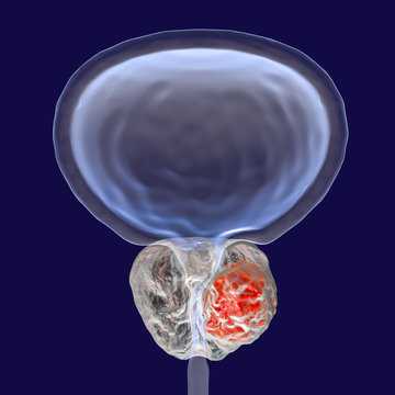 Prostate Cancer, 3D Illustration Showing Presence Of Tumor Inside Prostate Gland Which Compresses Urethra