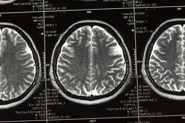 Brain scan, Neurology tomography concept