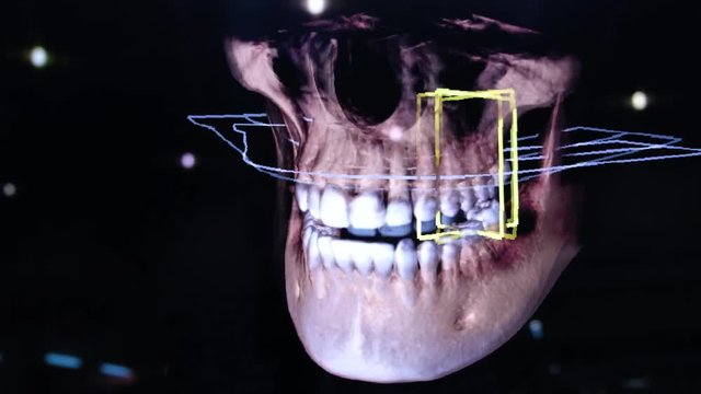 3D dental digital modeling restoration. 3d model of teeth, scanned teeth of the patient. The doctor is studying the tooth