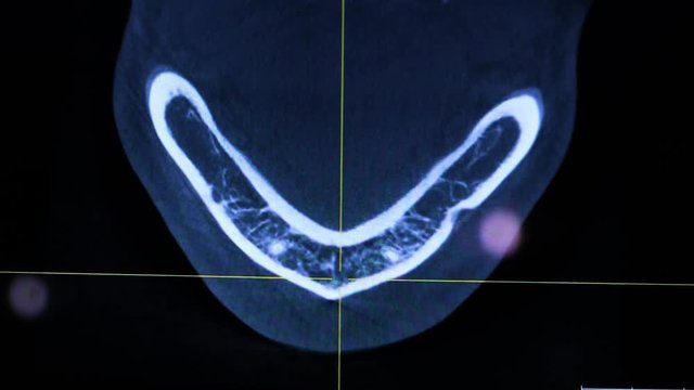 toothache symptom. X-ray of the human jaw on the computer. The doctor examines the patient's jaw, treats the tooth