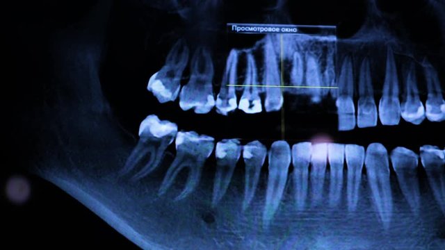 toothache symptom. X-ray of the human jaw on the computer. The doctor examines the patient's jaw, treats the tooth