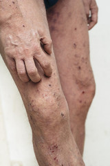 Fototapeta premium Man having itchy and dry skin problem