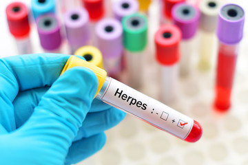 Obraz premium Herpes virus positive