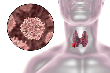 Fototapeta premium Thyroid cancer. 3D illustration showing thyroid gland with tumor inside human body and closeup view of thyroid cancer cells