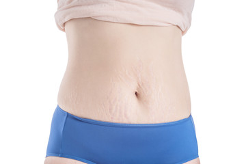 Asian woman belly skin with stretch mark scar over white background
