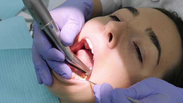 Female dentist polishing client's lower teeth.
